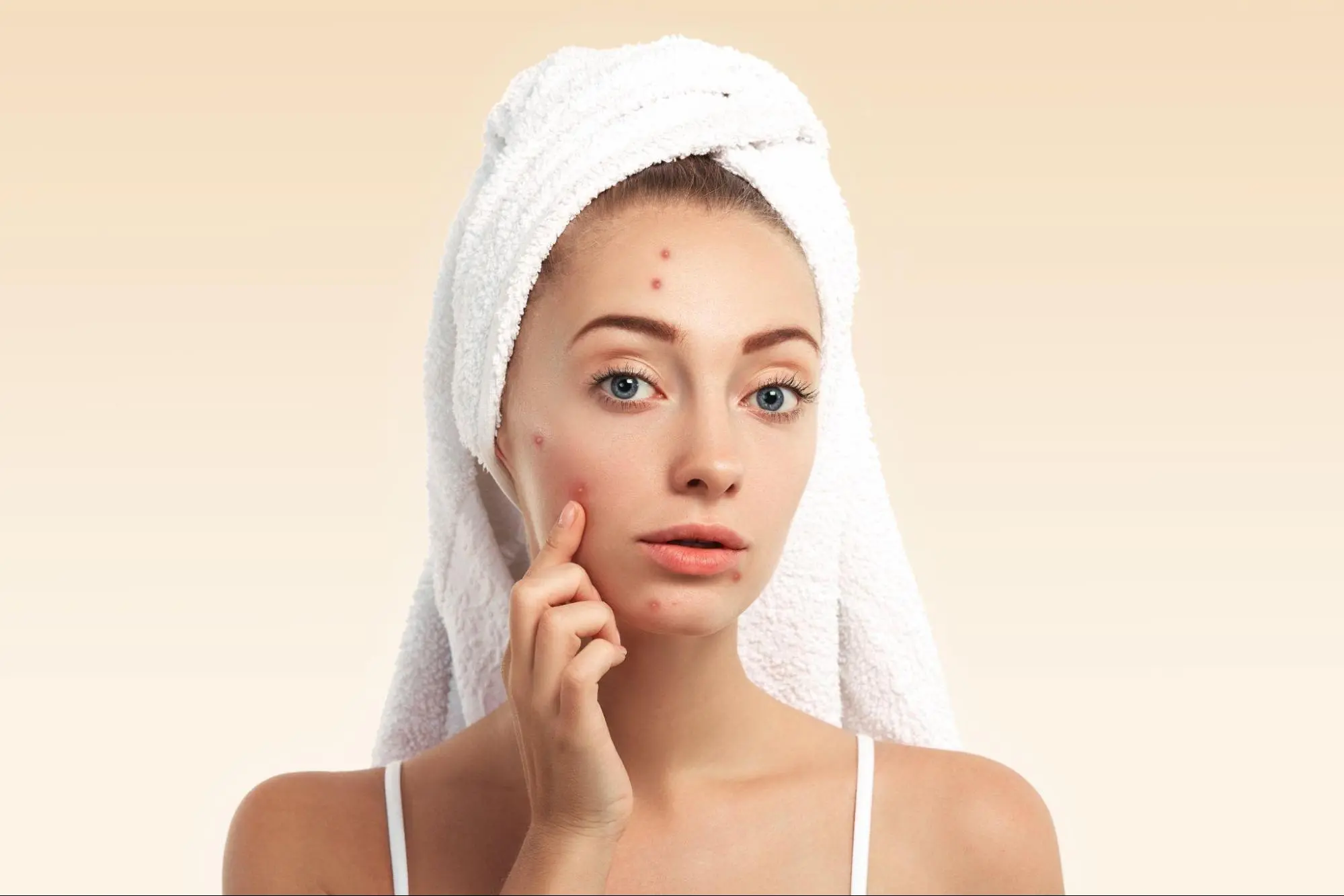 Urutan Skincare untuk Kulit Berjerawat, Yuk Simak!